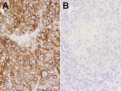  Immunohistochemical staining of formalin fixed paraffin embedded (FFPE) sections of (A) a cytokeratin7 (CK7)-positive human pancreatic adenocarcinoma and (B) a CK7-negative human squamous cell lung cancer engrafted into immunocompromised mice (xenografts) with rabbit anti-Cytokeratin7